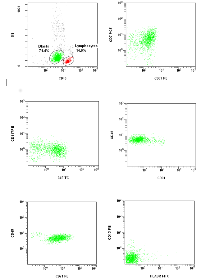 Figure 3. The immunophenotypic features of the blasts with flow cytometry study.